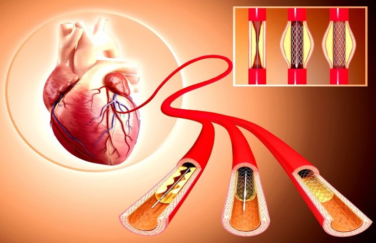 how-long-can-you-live-with-heart-disease-moscowforum